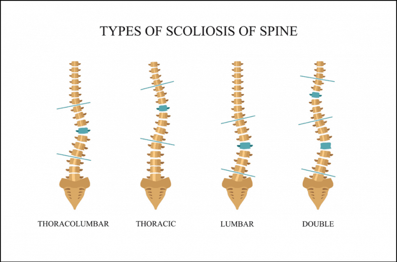 All You Need to Know About Scoliosis Pain - Lully Sleep